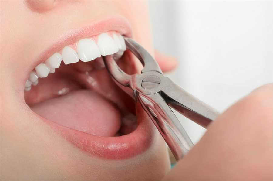 tooth extraction in dubai