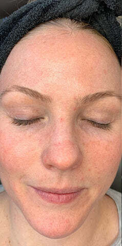 HydraFacial-Treatment-Before-and-After-Photos-03_83643006-0698-4db5-a15e-044d37b603d3_480x480 (1)