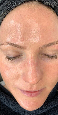 HydraFacial-Treatment-Before-and-After-Photos-03_83643006-0698-4db5-a15e-044d37b603d3_480x480 (2)