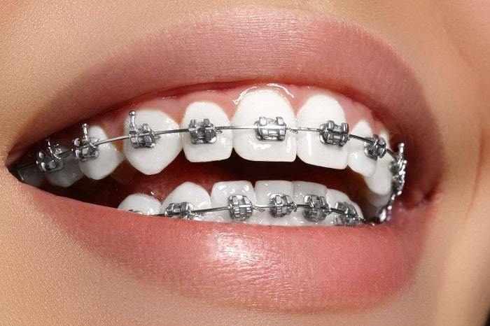 Metal-brace-to-align-and-straighten-crowded-teeth-min-1