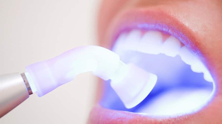 laser teeth whitening dubai