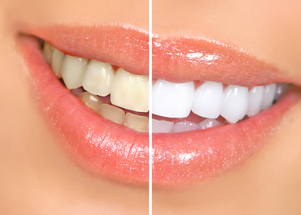 teeth cleaning results