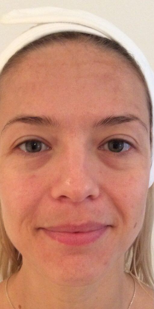 hydrafacial-treatment-before-after-1024x1024-1-1024x1024 (1)