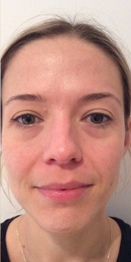hydrafacial-treatment-before-after-1024x1024-1-1024x1024 (2)