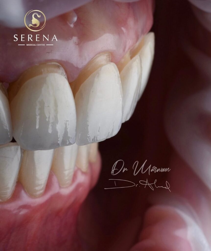 Transform Your Smile with Veneers & Lumineers in Deira, Dubai Serena
