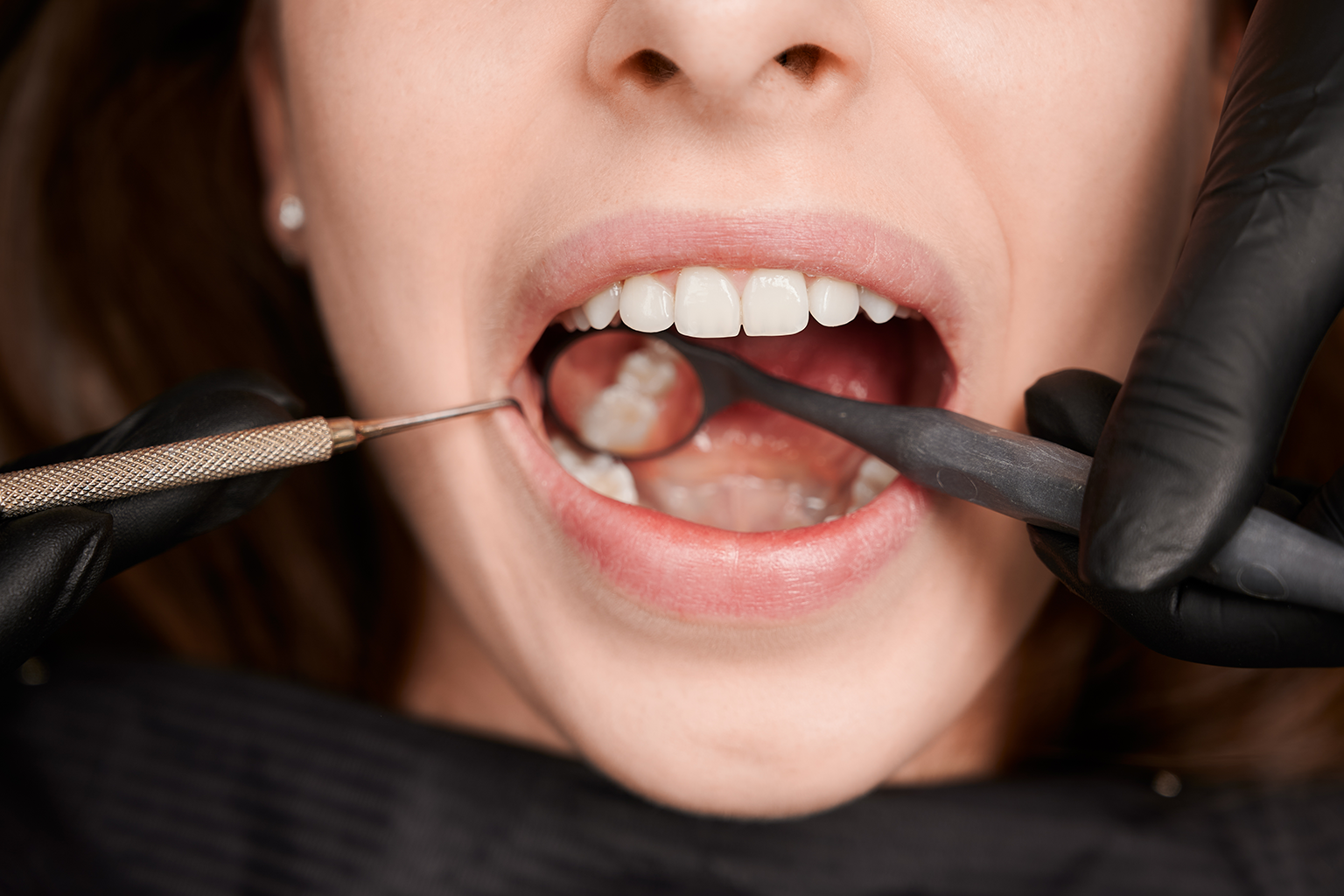 Impact Of Veneers On Dental Health: What To Expect Before And After?