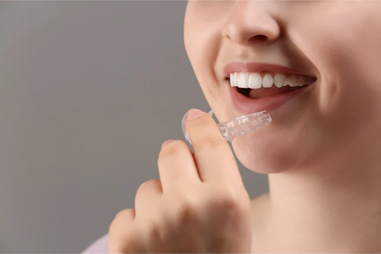 A Comprehensive Guide To Clear Aligners