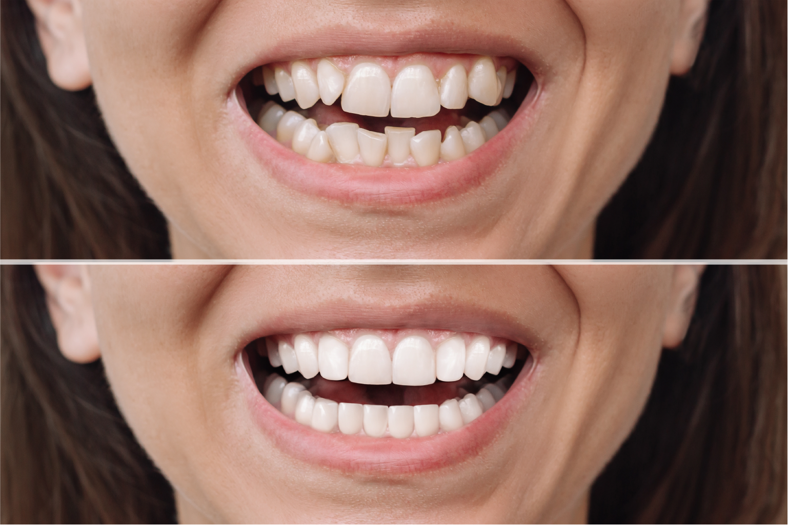 After Smile Makeover with Dental Crown