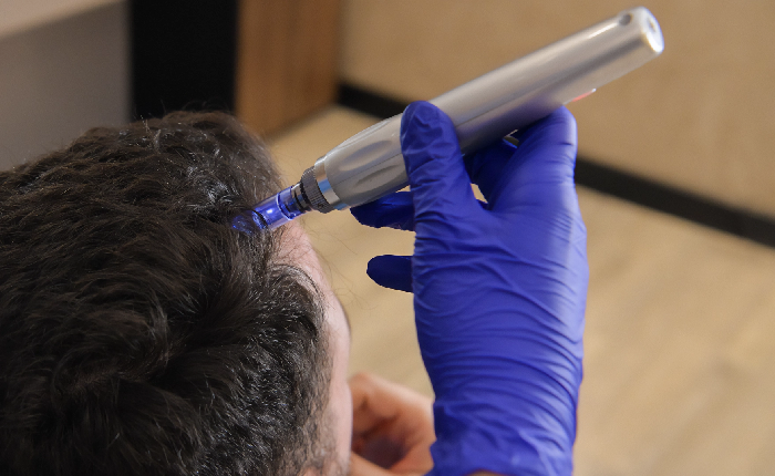 Close-up of platelet-rich plasma using derma pen on patient's scalp