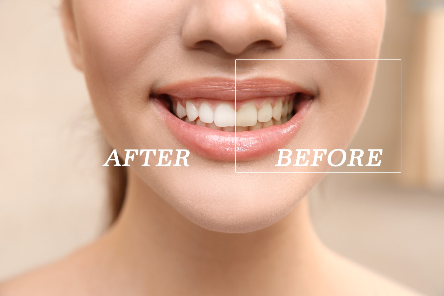 Close-up of a woman's bright, white teeth after professional teeth whitening