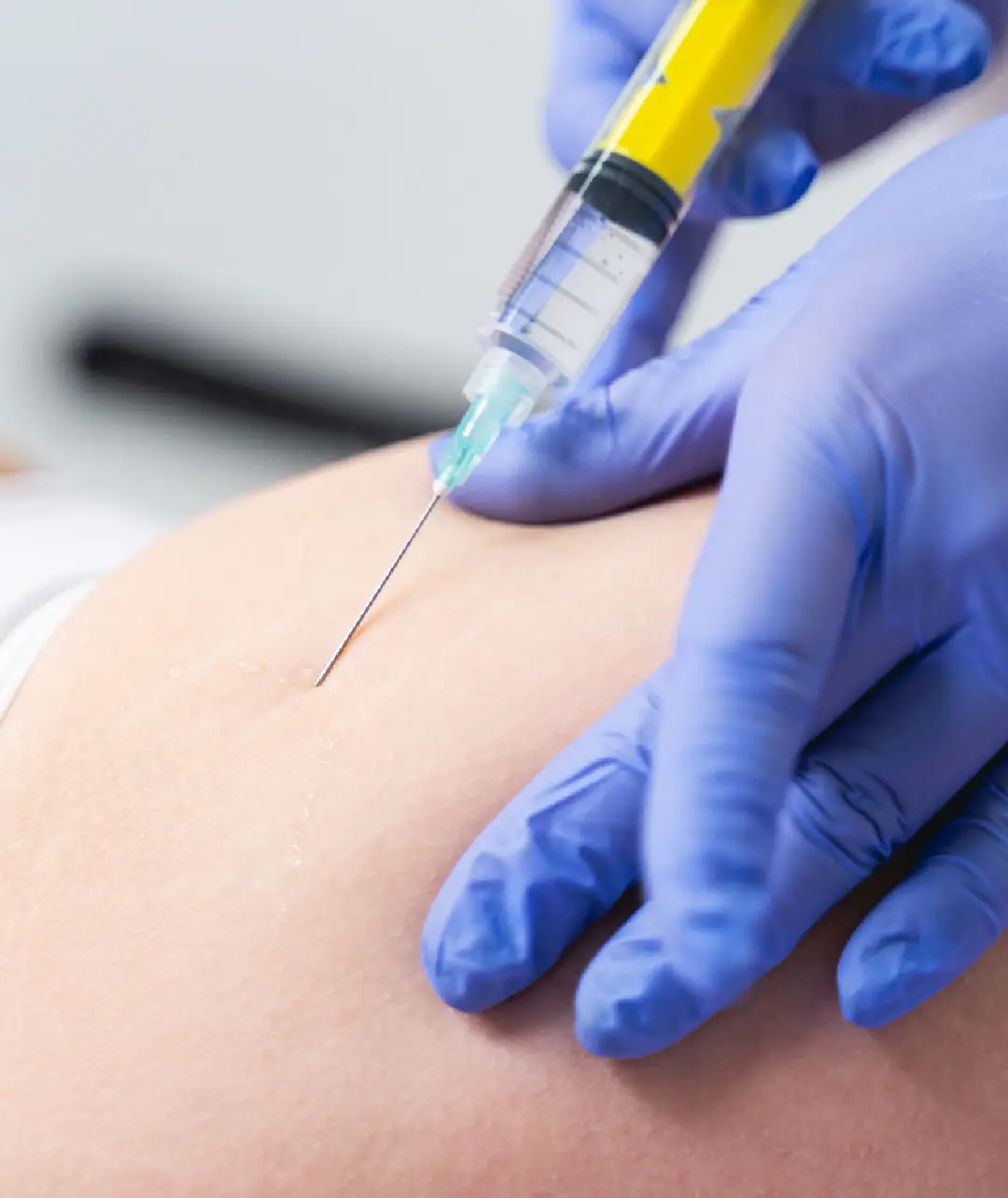 Fat-melting treatment for belly fat with mesotherapy injection