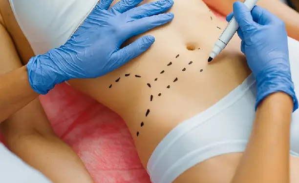 Medical professional marking target areas on the abdomen for mesolipo fat melting injections