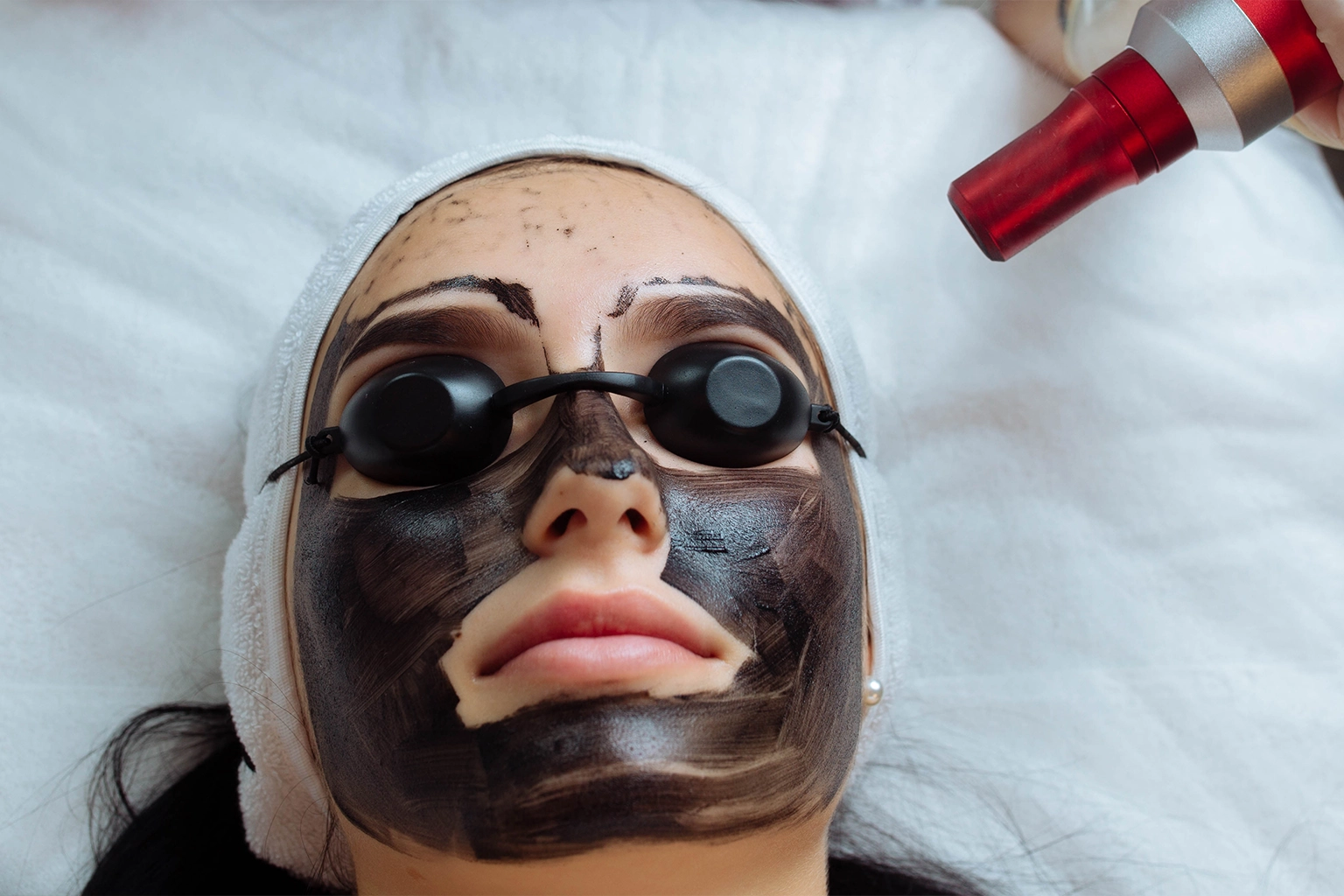 Woman undergoing carbon laser peel with a black carbon mask applied to her face, wearing protective eye goggles during treatment