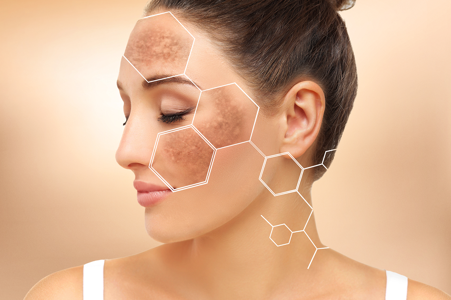 Illustration showing hyperpigmentation at a cellular level on facial skin