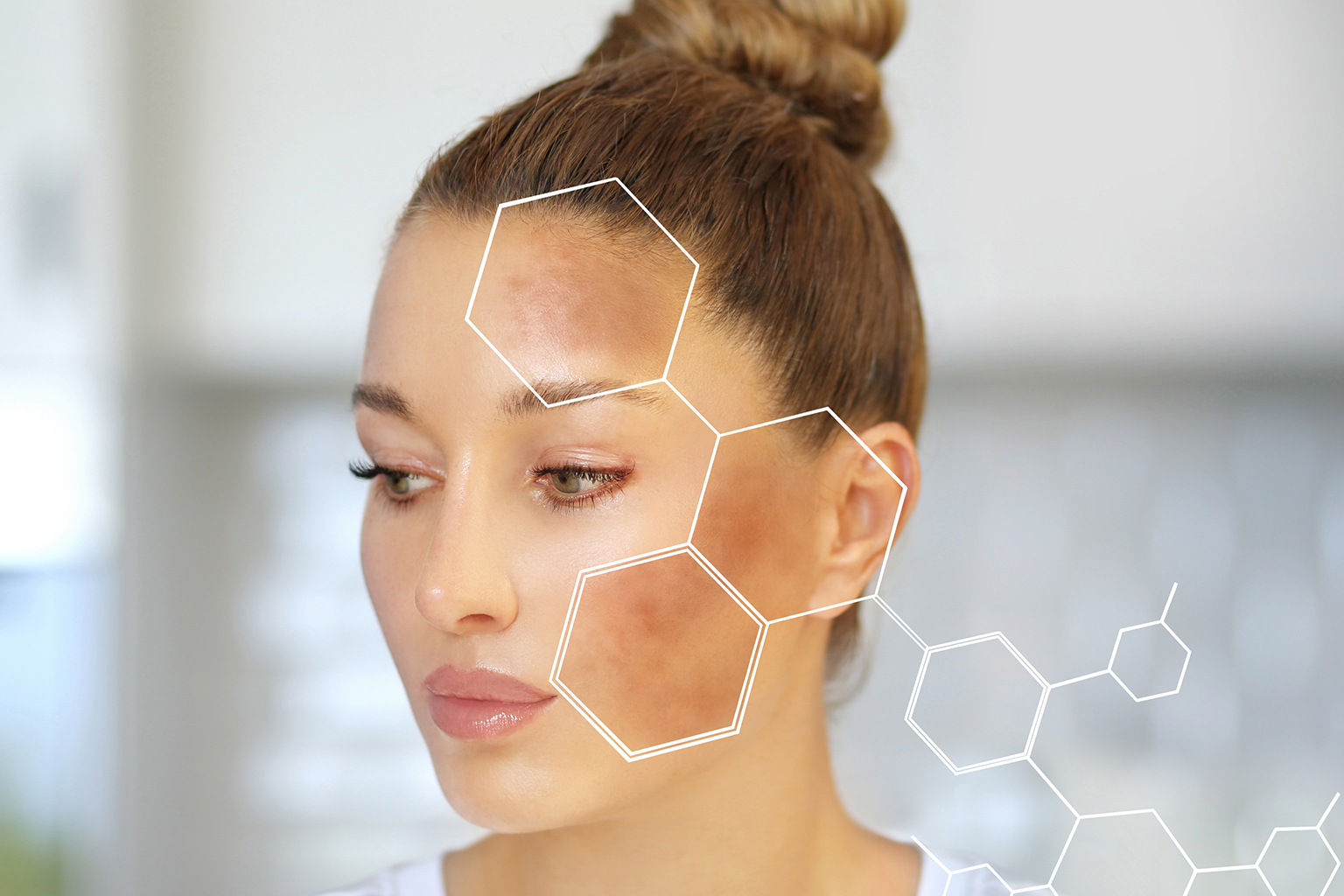 A woman’s face showing areas of hyperpigmentation on the skin