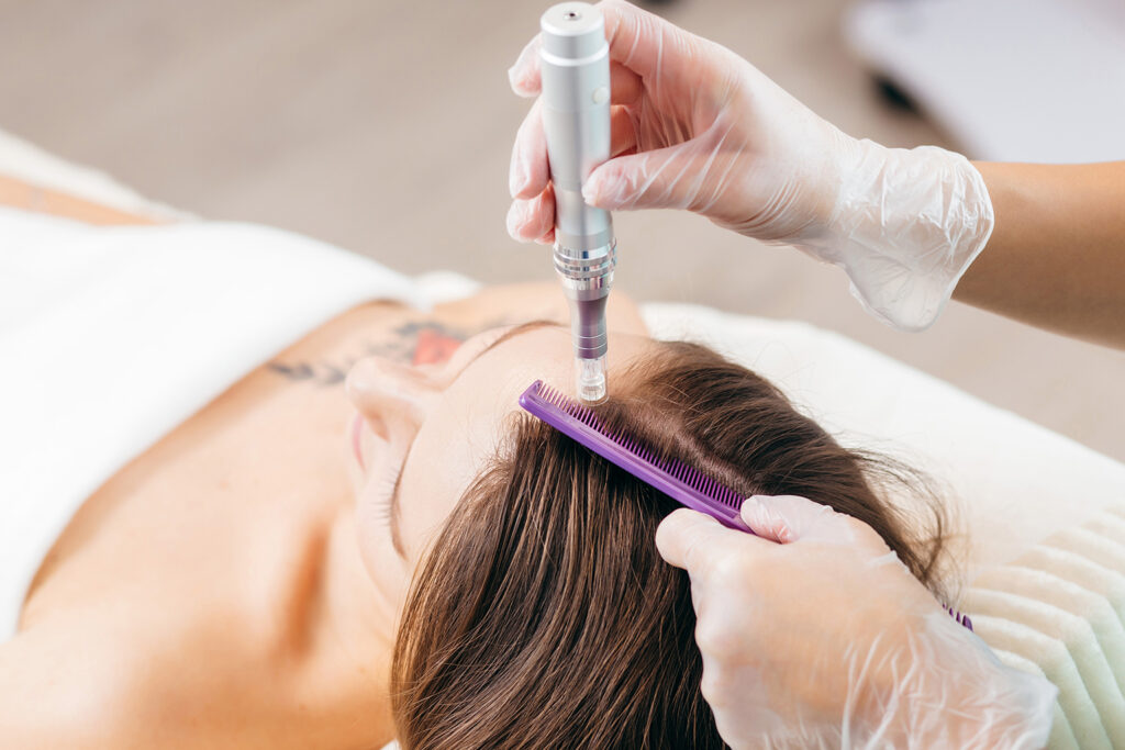 PRP hair treatment being applied to the scalp