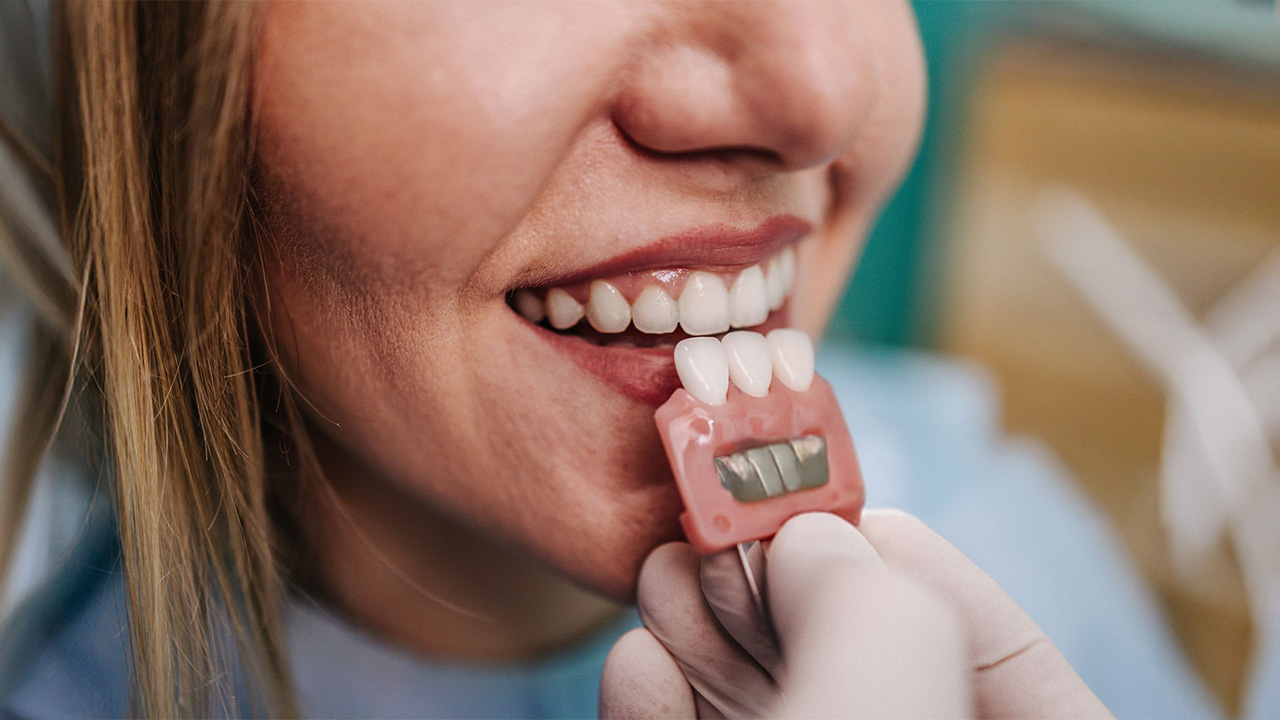 A dentist placing dental veneers on a patient’s teeth