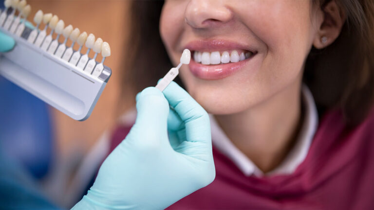 How Long Do Veneers Last Its Lifespan, Care Tips & What Affects Durability