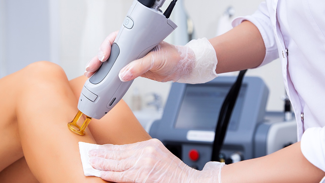 Laser hair removal treatment being performed on a woman’s leg.