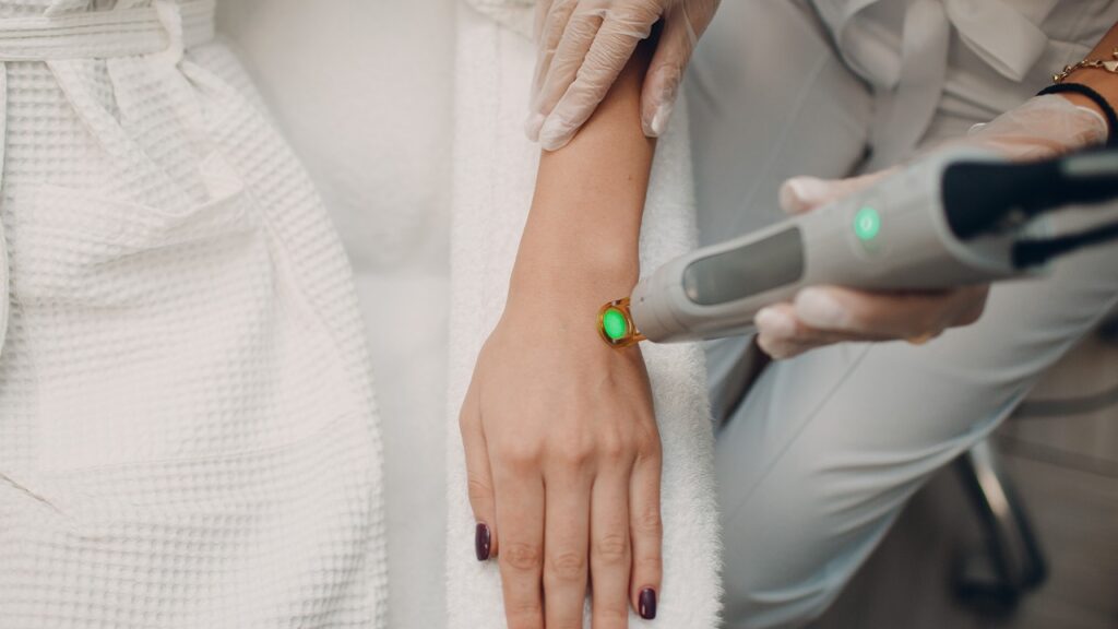 Laser hair removal treatment being performed on the hand