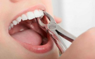 tooth extraction in dubai