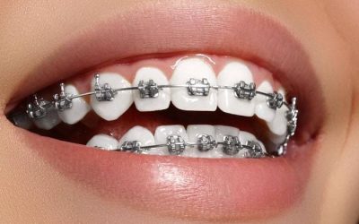 Metal-brace-to-align-and-straighten-crowded-teeth-min-1