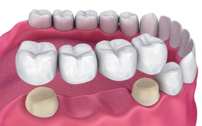 ds-dental-bridges