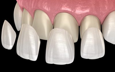 veneers-1-1080x675